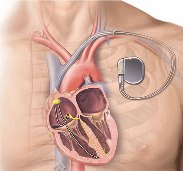 Springfield Heart Surgeons Dual Chamber Pacemaker