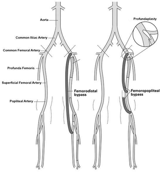 Femoral Popliteal Bypass Surgery