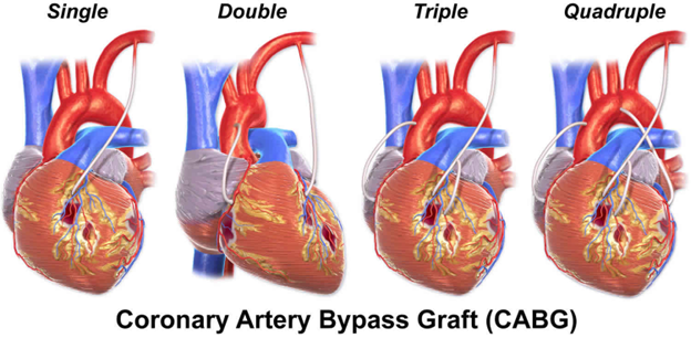 Heart Bypass Surgery Coronary Artery Bypass Graft