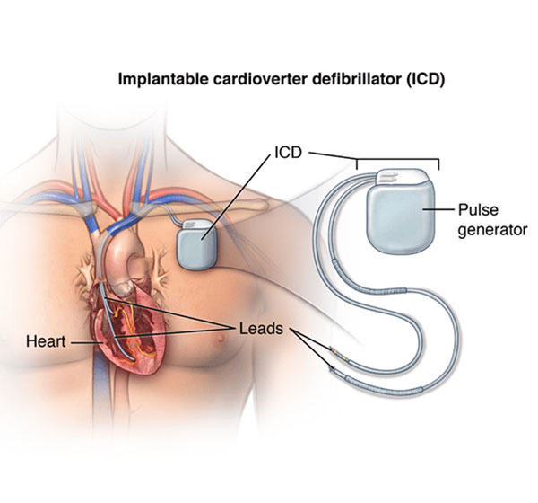 Springfield Heart Surgeons Implantable Cardioverter Defibrillator ICD