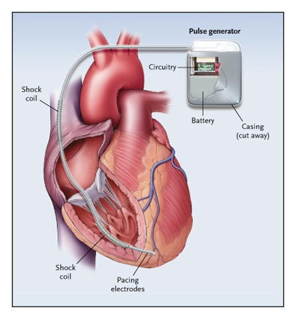 Springfield Heart Surgeons Single Chamber Pacemaker