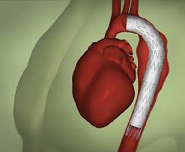 Springfield-Heart-Surgeons-Abdominal-Aortic-Aneurysm-Open-Repair