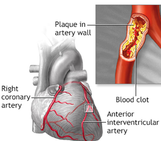 Springfield Heart Surgeons Coronary Artery Disease Surgery Treatment Options