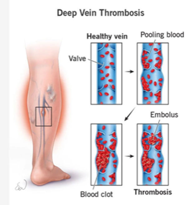 Springfield Heart Surgeons Deep Vein Thrombosis Signs Symptoms