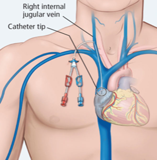 Springfield Heart Surgeons Dialysis