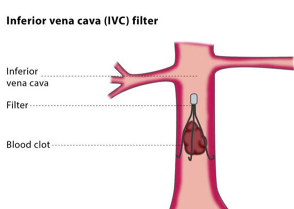 Springfield Heart Surgeons Inferior Vena Cava (IVC) Filter Placement