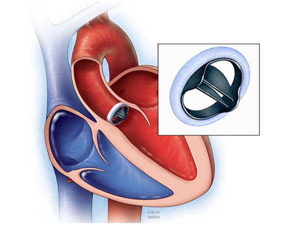 Springfield Heart Surgeons Mitral Valve Repair Replacement Before & After