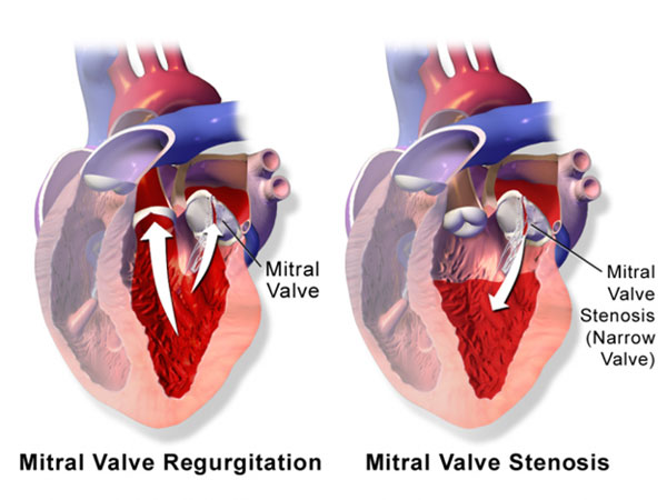 Springfield Heart Surgeons Mitral Valve Repair Replacement