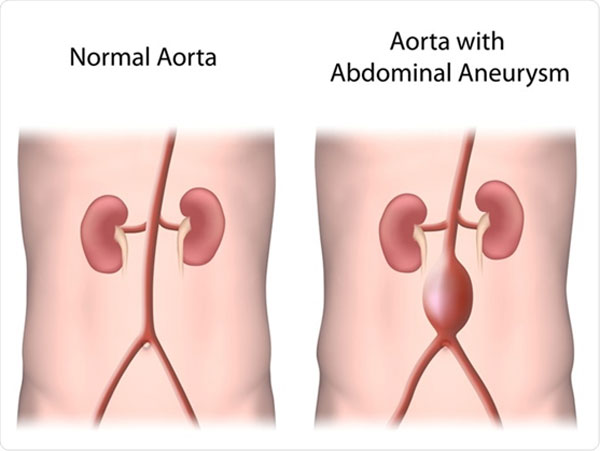 Springfield Heart Surgeons Normal Aorta Aorta With Abdominal Aneursym